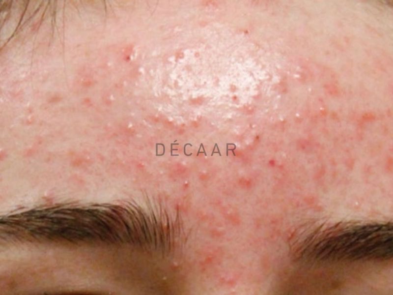 mụn trứng cá bọc